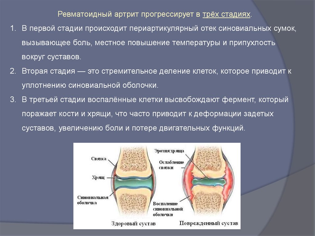 Изменение формы сустава. Ревматоидный артрит морфологическая характеристика стадий синовита. Степени артрита коленного сустава ревматоидный. Изменения суставов при ревматоидном артрите. Понятие о остеоартрозе.
