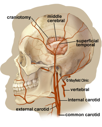 cerebral bypass