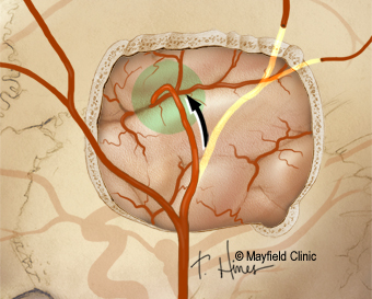 cerebral bypass