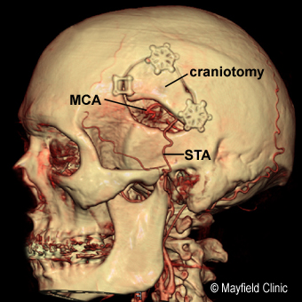 cerebral bypass