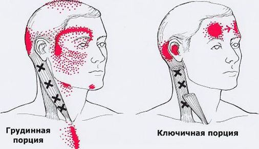 Триггеры: Карта точек боли и напряжения в теле 