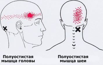 Триггеры: Карта точек боли и напряжения в теле 