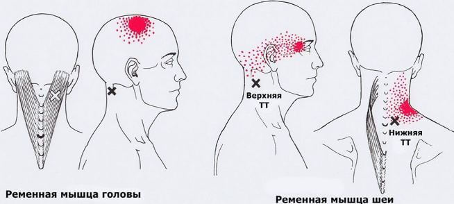 Триггеры: Карта точек боли и напряжения в теле 