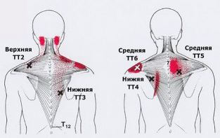 Триггеры: Карта точек боли и напряжения в теле 