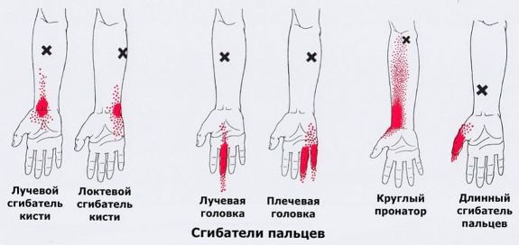 Триггеры: Карта точек боли и напряжения в теле 