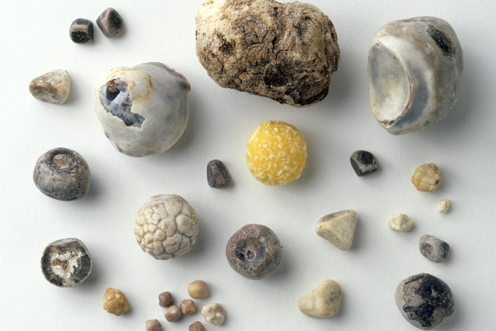 Билирубиновые (пигментные) камни