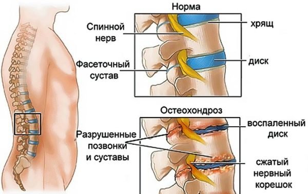 Остеохондроз поясничного отдела позвоночника