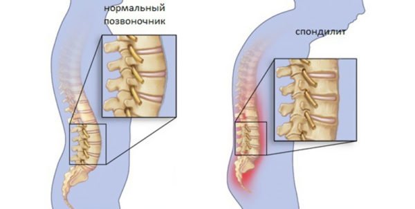 Спондилит