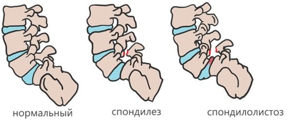 Заболевания позвонков поясничного отдела