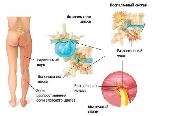 Защемление седалищного нерва