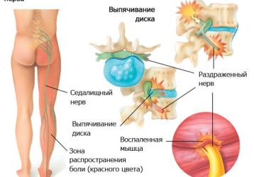 Как и чем лечить прострел в пояснице: причины острой боли, методы лечения