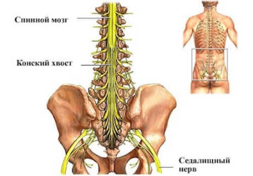 Симптомы и лечение синдрома конского хвоста в пояснице
