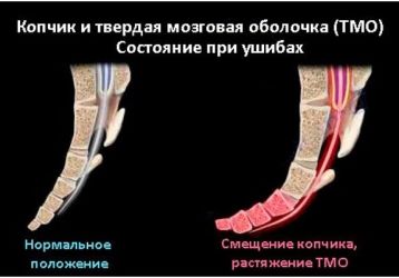 Основные причины смещения копчика, методы диагностики и лечения