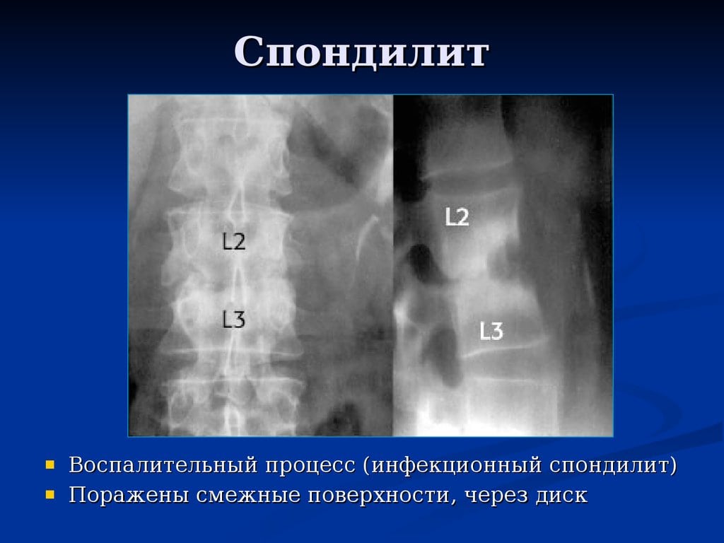 Артрит сустава 