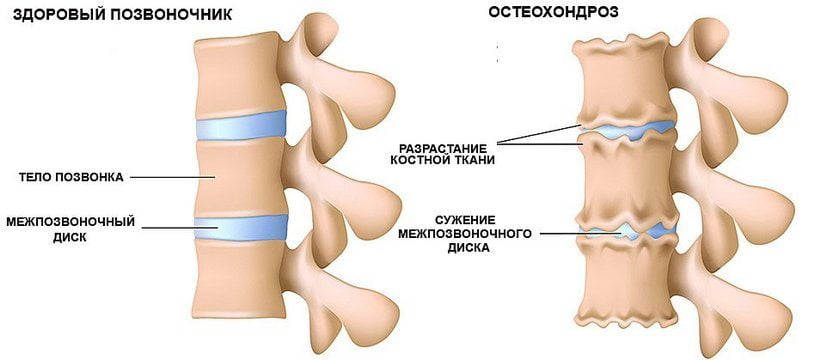 Остеохондроз позвоночника