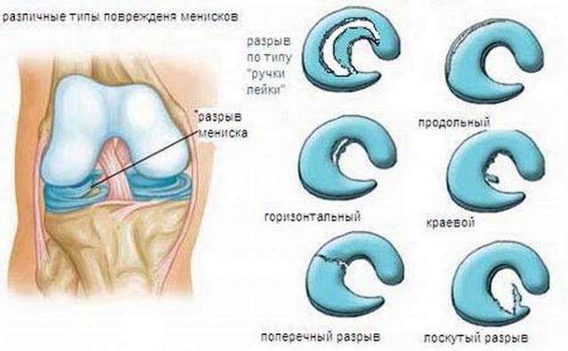 Разрыв мениска