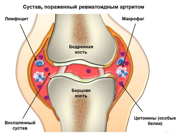 Ревматоидный артрит