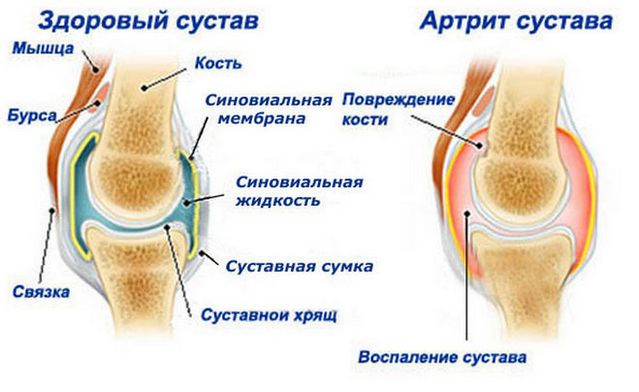 Пораженный артритом сустав