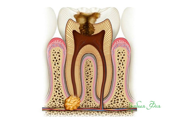 гранулема зуба