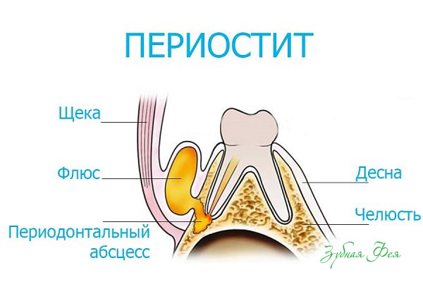 периостит зуба