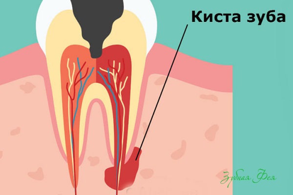 киста зуба