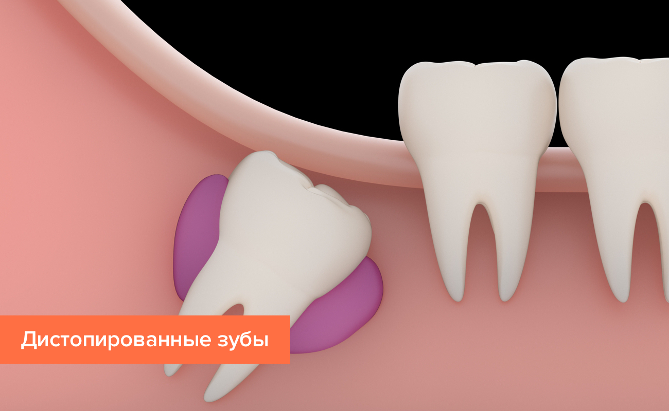 Дистопированные зубы в картинках