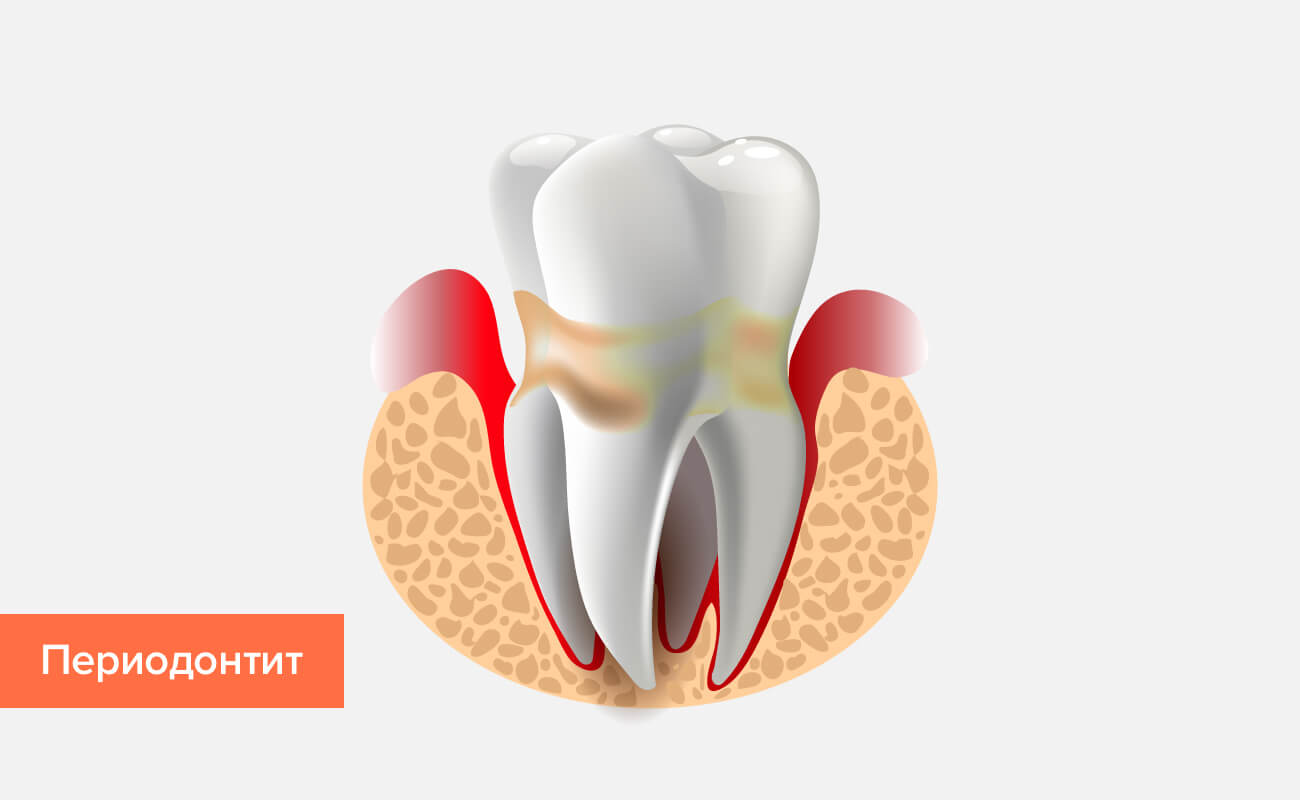 Периодонтит зуба в картинках