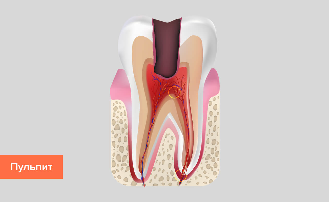 Пульпит зуба в картинках