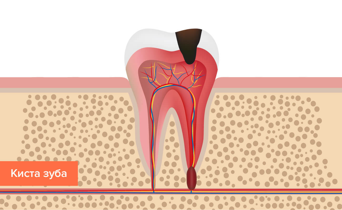 Киста зуба в картинках